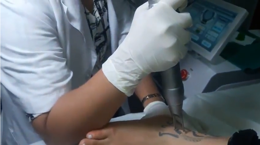 Q-switched tattoo removal video 