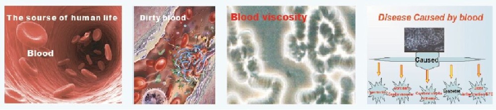 Hemotherapy Laser High Blood Sugar Viscosity Cholesterol Lower Level Therapy Laser Watch