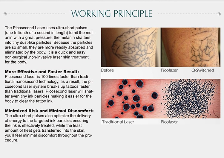 1500mj high energy skin rejuvenation and all tattoo removal pico laser for wrinkles
