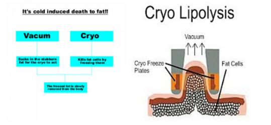 Cryolipolysis nubway for weight loss portable home cryolipolysis liposuction machine