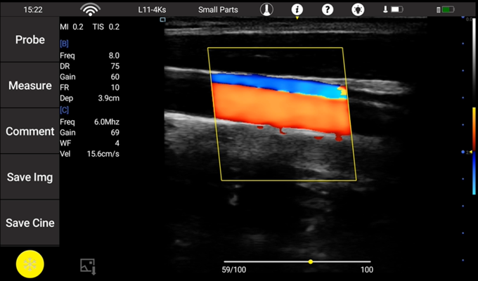 Transvaginal Ultrasound Probe Wireless Ultrasound Probe Convex Linear Cardiac Probe Detachable