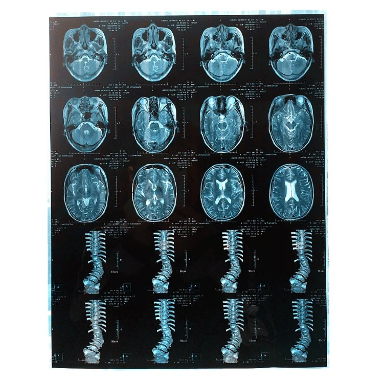 Factory Price 14*17 in Cr Dr Mrt Digital Dry Medical X-ray Film Medical Thermal Blue Film