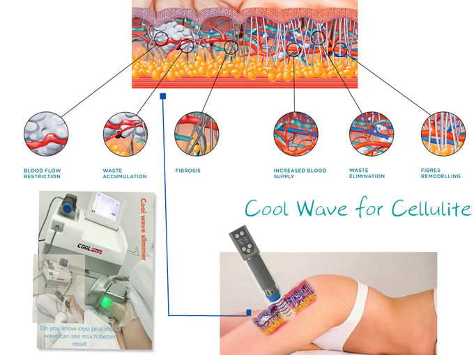 Cool wave body slimming shockwave therapy cryolipolysis machine Erectile Dysfunction
