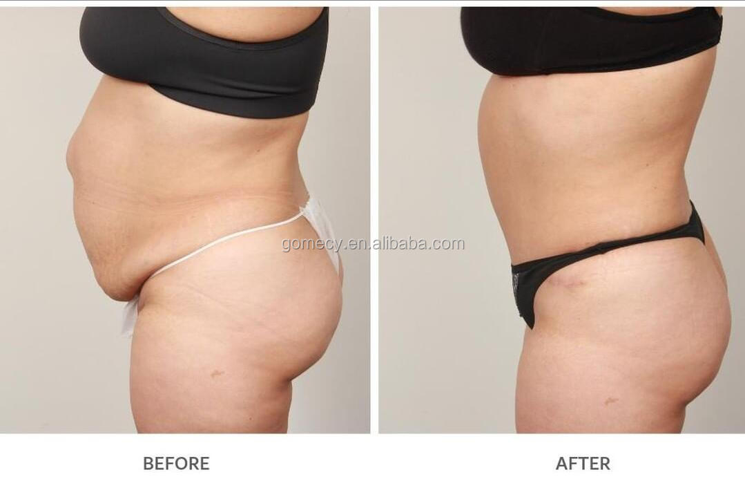 before after body slimming cryolipolysis