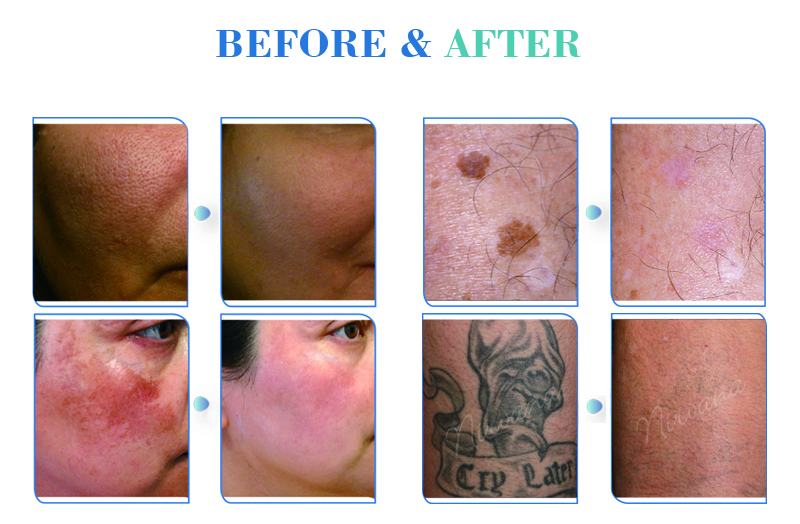 best way to removal tattoo picosecond laser tattoo removal