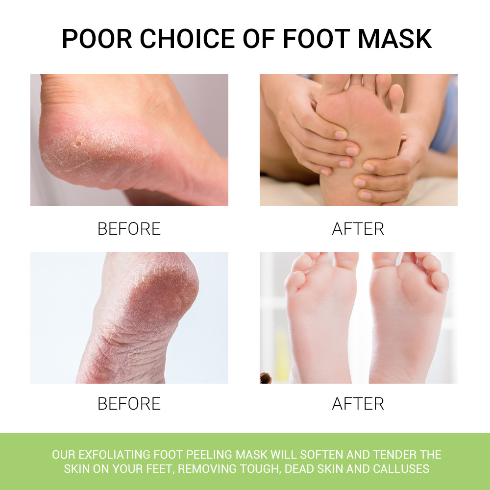 dry peeling , foot mask