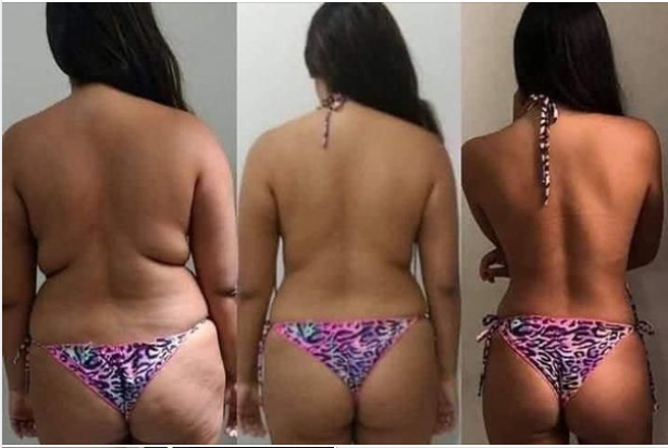 before after body slimming cryolipolysis