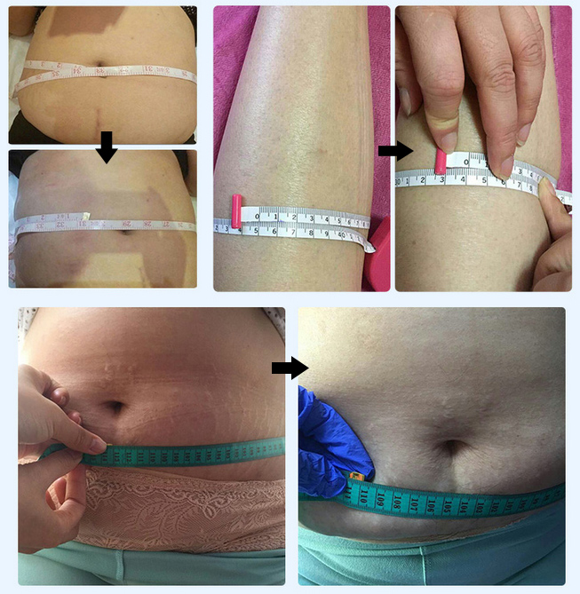 1064nm ND YAG Laser Lipolysis Liposuction Slimming Medical Machine (JCXY-B4)