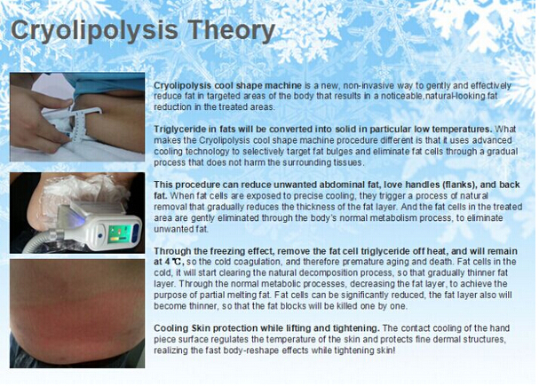 Cryolipolysis theory.jpg