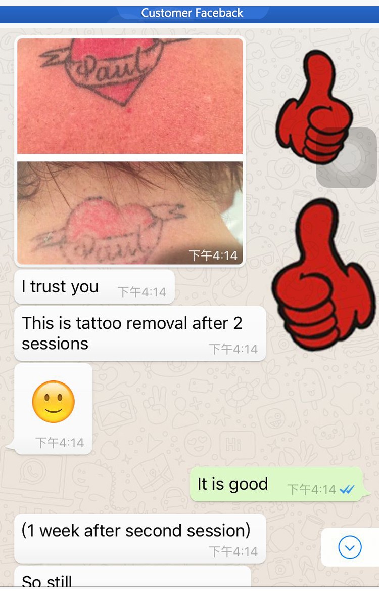  Q-Switched Nd Yag Laser Tattoo Removal .jpg