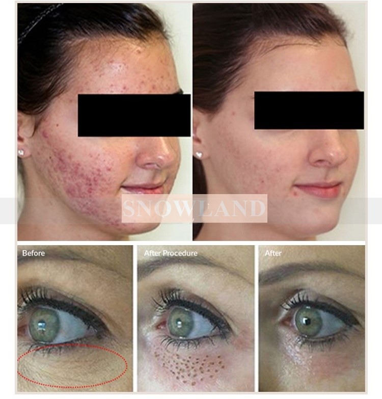 acne removal machine.jpg