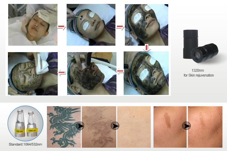 luxury laser tattoo removal machine with 1064nm, 532nm, 755nm, 1320nm and fractional 5 tips