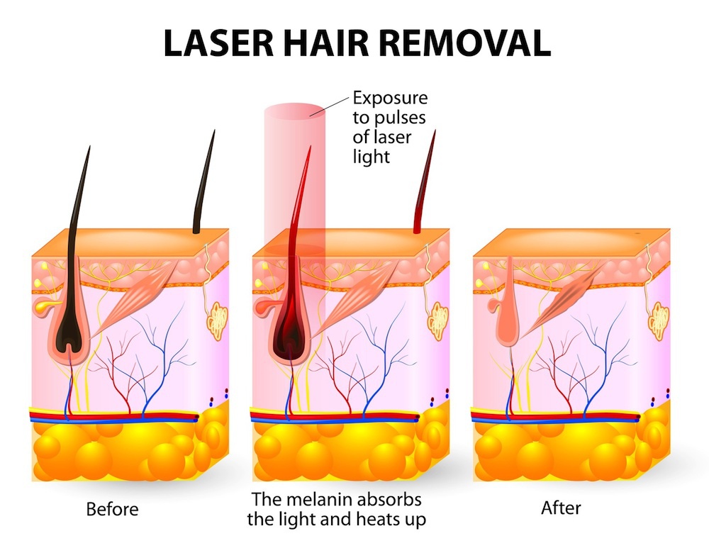 laser-hair-removal-info.jpg