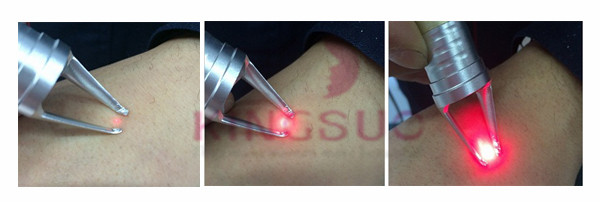 Medical 980nm diode laser spider vein removal/980nm diode laser/980nm medical laser