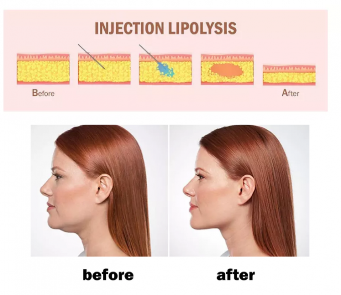 Skin Care Slimming Lipolysis Injection For Body Neck 1