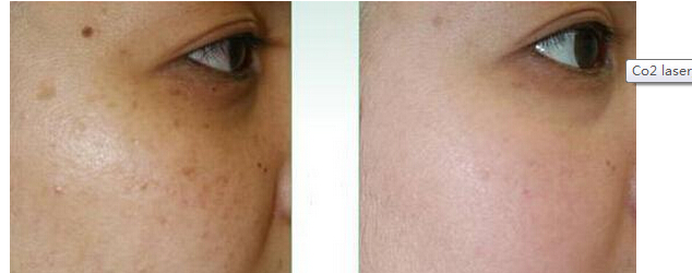 White Skin Rejuvenation Laser Acne Scar Removal Apparatus 10600nm Wavelength