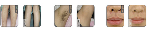 Diode laser hair removal results.png