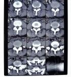 10in * 12in films secs d'imagerie médicale à haute densité de 11in * de 14in pour l'imprimante d'AGFA/Fuji