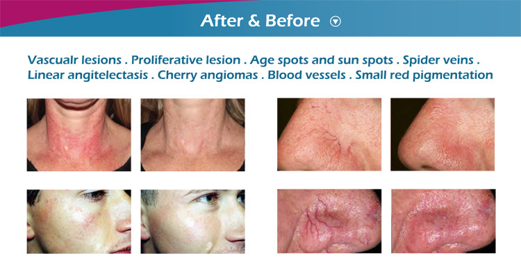 Excellent results multi spot high power diode 980nm laser vein removal