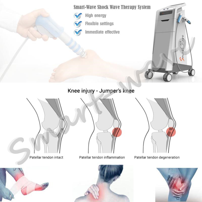 FDA Approved china factory smartwave shockwave pain relief CE extracorporeal shock wave therapy equipment