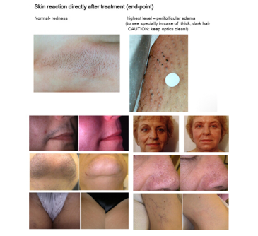 diode laser 808nm 810nm remove undesired hairs permanently.jpg