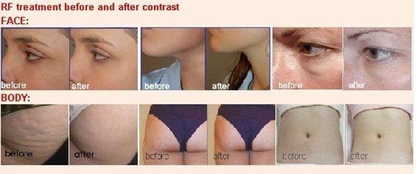 Slimming Liposuction product,Thermal slimming body reshaping beauty equipment