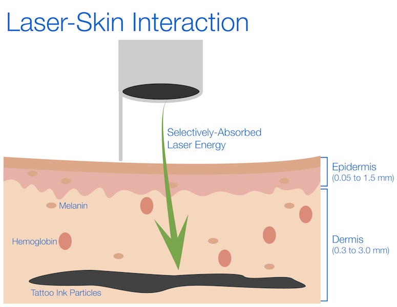 Laser-Skin-Interaction1.jpg