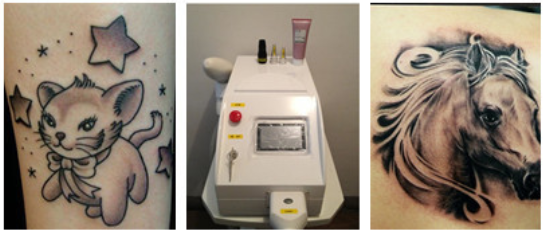 Christmas Promotion! Beijing Sanhe manufacturer portable q switched nd yag laser tattoo removal