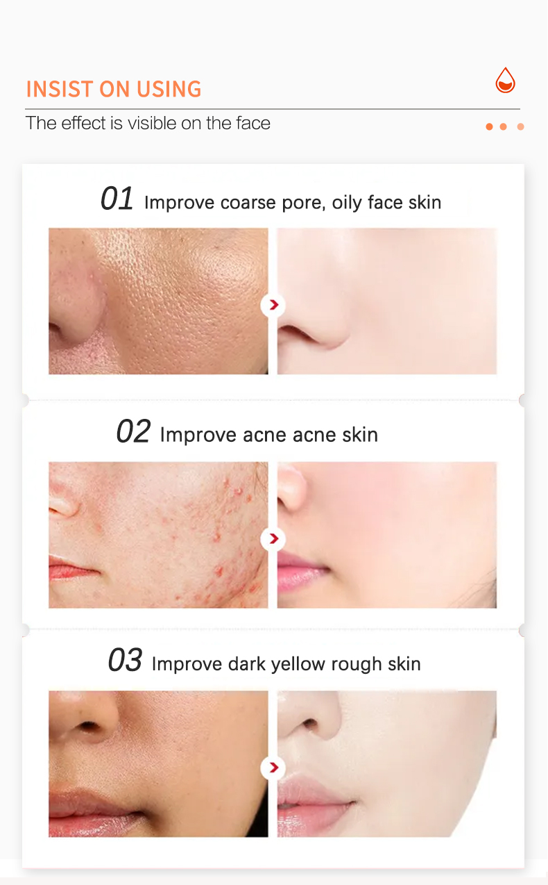 toner for acne prone skin