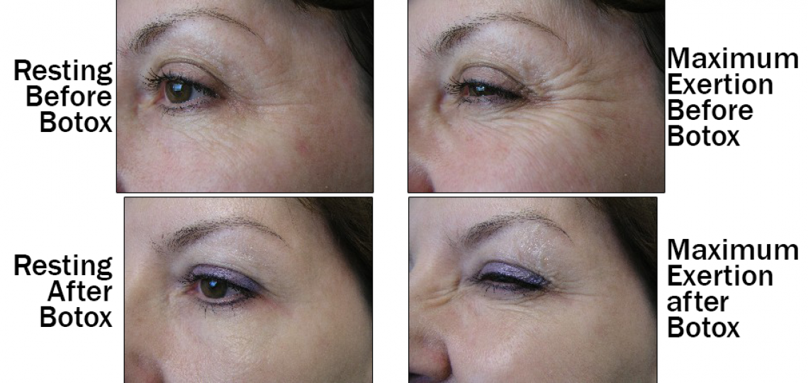 Botox for Wrinkles | Baylor Medicine