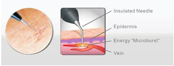Immediately result spider vein removal varicose veins laser treatment machine/vascular surgical instruments