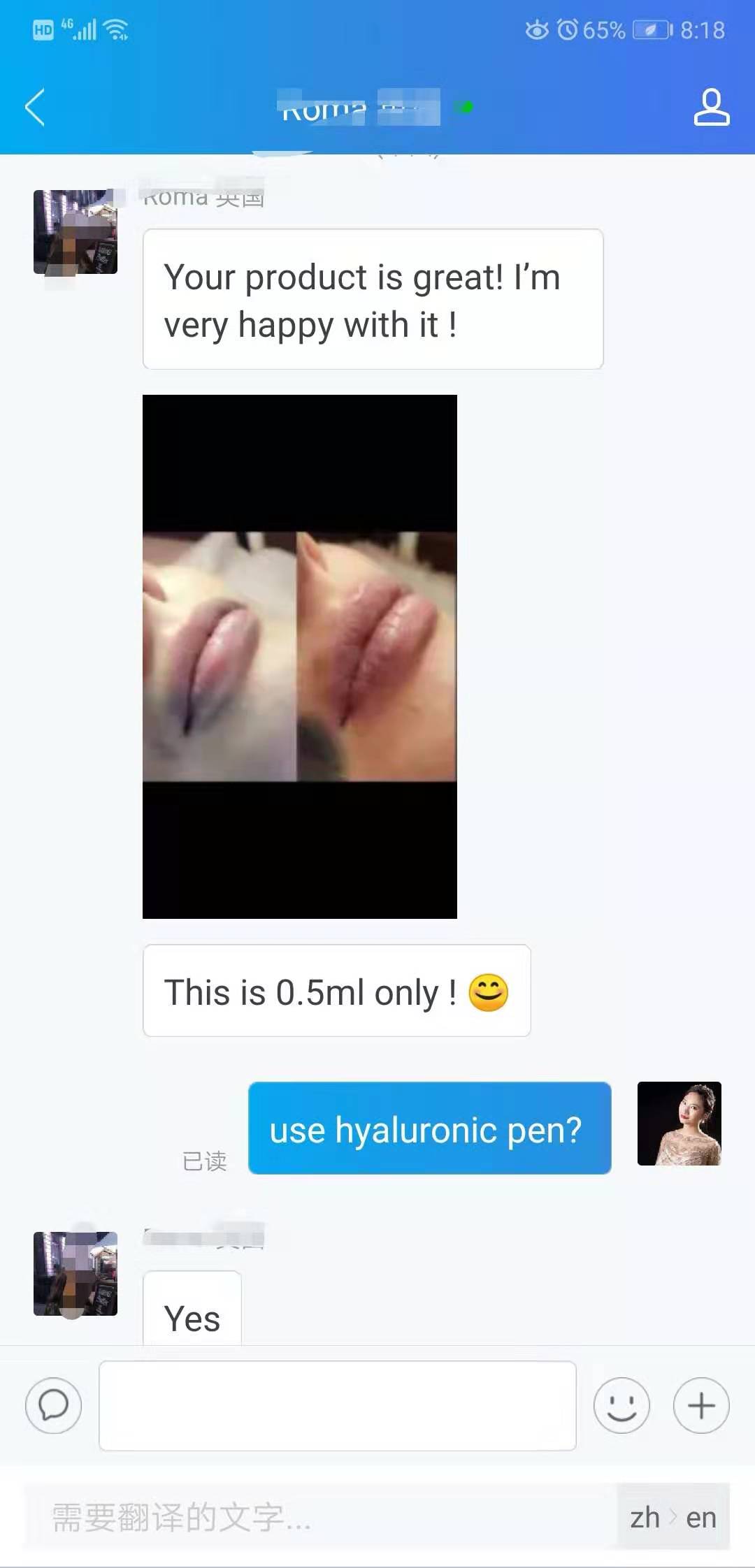 hyaluron pen lip filler before and after