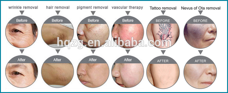 US002H 4H GLOBALIPL Remove All Unwanted Hair Without Any Pain