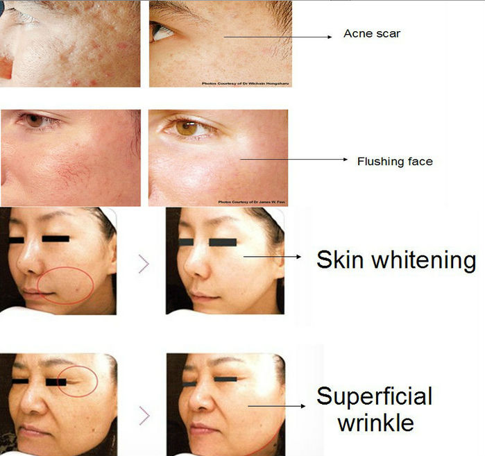 Remarkable treatment effect for Wrinkle Remover and skin rejuvenation professional rf co2 fractional laser beauty machine