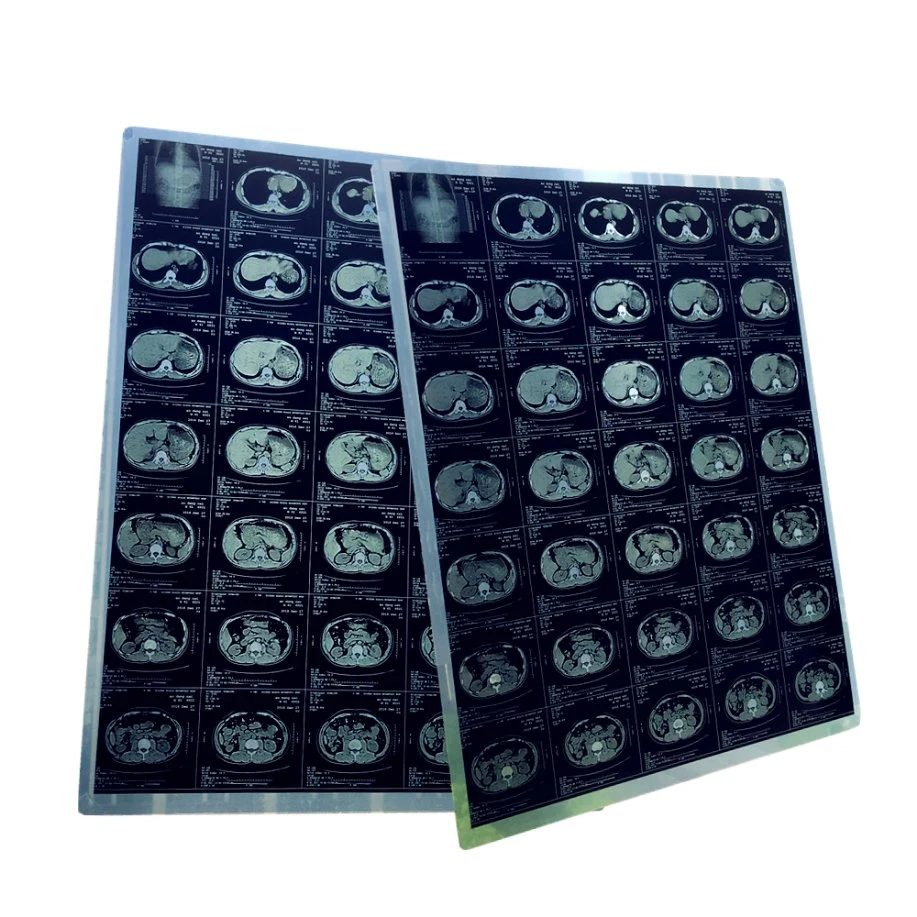 Factory Price 14*17 in Cr Dr Mrt Digital Dry Medical X-ray Film Medical Thermal Blue Film