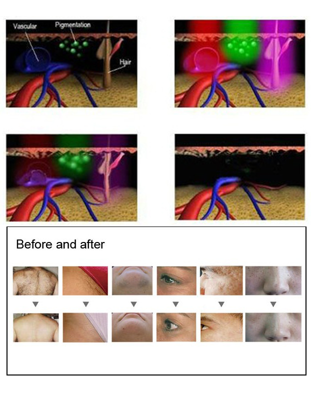 2021 trending product alibaba online shop hot seller stationary medical SHR IPL Laser Beauty Equipment