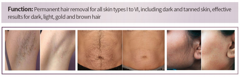 diode laser hair removal treatment result