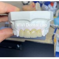 China Zirconia Crowns PFZ Zirconia Porcelain Crown Dental Tooth Crown on sale