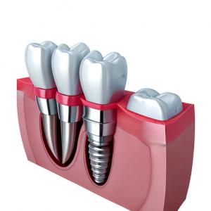 Elevating Standards Our Dental Implant Crown Quality Assurance