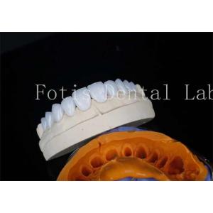 Porcelain Dental Lab Veneers Bonding Cement For Long Lasting Restorations