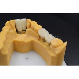 Customizable Dental Restoration Implant Crown Replacement Various Sizes