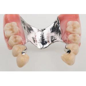 Dental Precision Attachment Partial Denture Ivoclar Scheftner