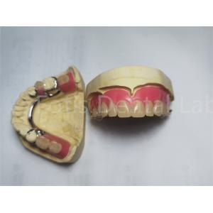 Comfortable Peek Partial Denture / Removable Dental Prosthesis Customized