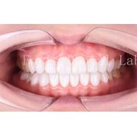 China High Translucency Dental Laminate Veneers Long Lasting Durability Polishing Finishing on sale