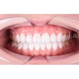 High Translucency Dental Laminate Veneers Long Lasting Durability Polishing Finishing