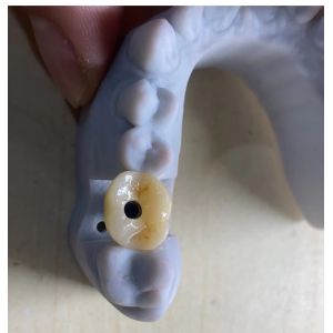 China High Precision Implant Supported Crown Stable And Easy Maintenance wholesale