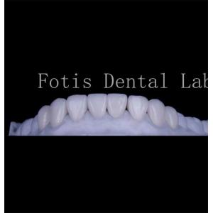 Long Lasting Smooth Texture Teeth Cover Veneers Natural Dental Veneers
