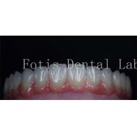 China Smooth Surface Cosmetic Tooth Coverings Natural Porcelain Veneers Customizable on sale