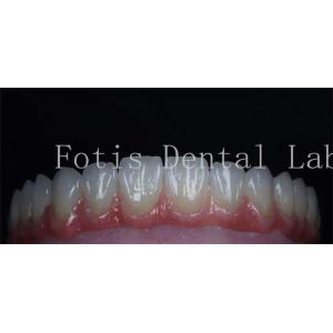 Smooth Surface Cosmetic Tooth Coverings Natural Porcelain Veneers Customizable