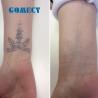 China Picosecond Laser Tattoo Removal Machine Nd Yag Tattoo Remove Machine Picolaser Laser Pico Q-switch Carbon Laser Peel Machine wholesale